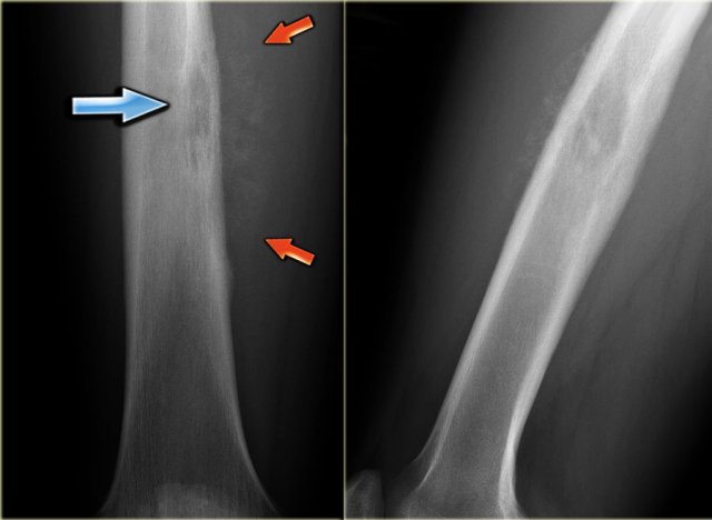 The Radiology Assistant : Osteolytic - ill defined bone tumors